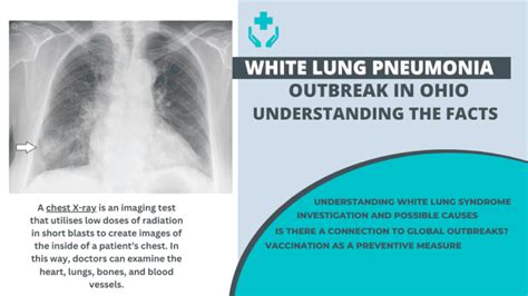 White lung pneumonia outbreak